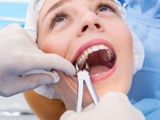 Nhổ răng để niềng tạo khoảng trống giúp răng di chuyển đúng vị trí