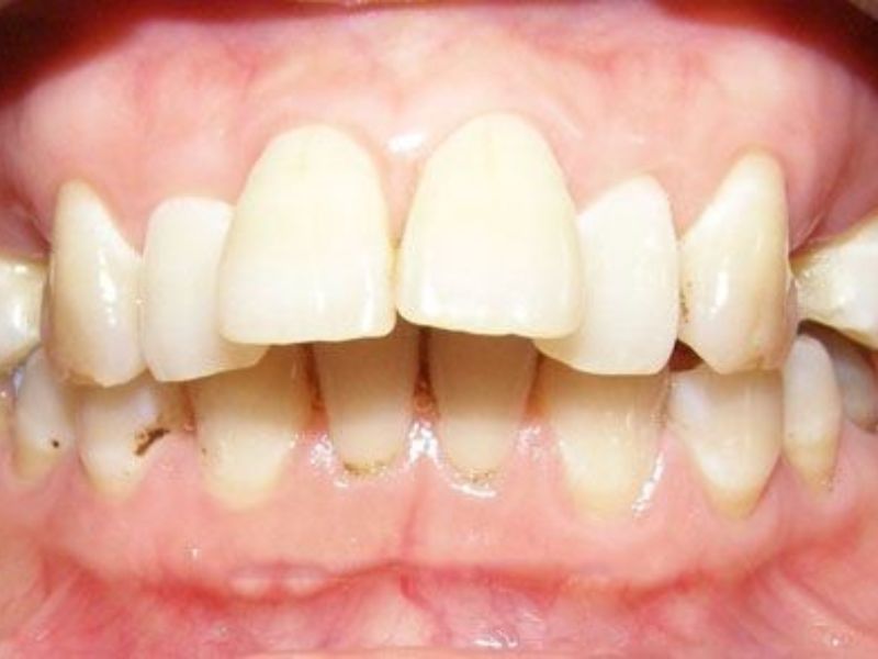 Các trường hợp niềng răng có thể cần nhổ răng như chen chúc nặng và hô do răng