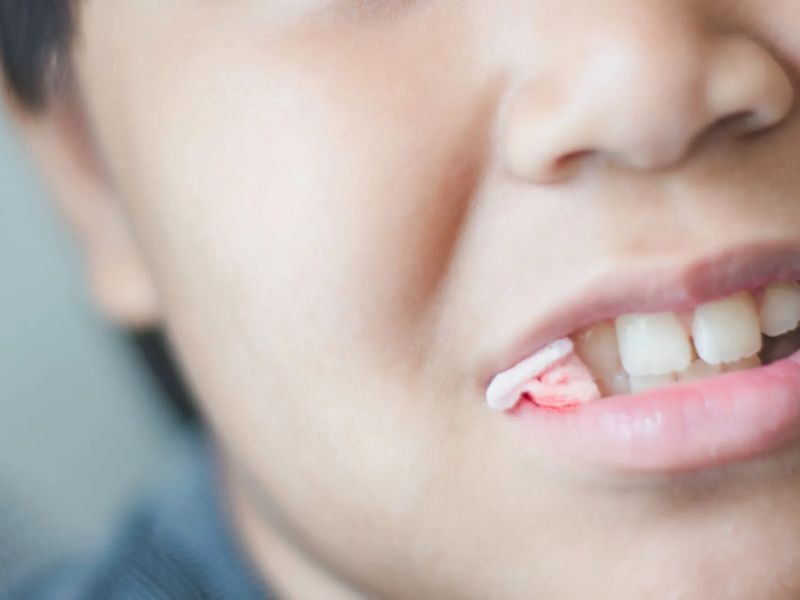  Hướng dẫn chăm sóc sau nhổ răng để niềng giúp giảm rủi ro