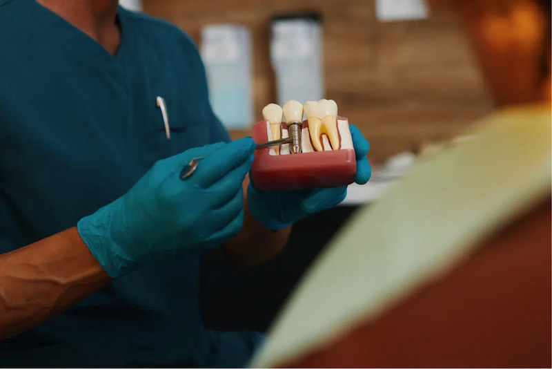 Trồng răng sớm sau khi nhổ răng số 7 giúp giảm nguy cơ bị hóp má