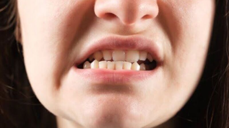 Tự niềng răng bằng silicon có thể gây lệch khớp cắn và tổn thương răng