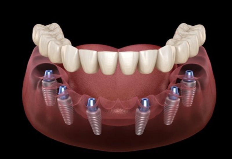 Implant toàn hàm không phù hợp để niềng răng