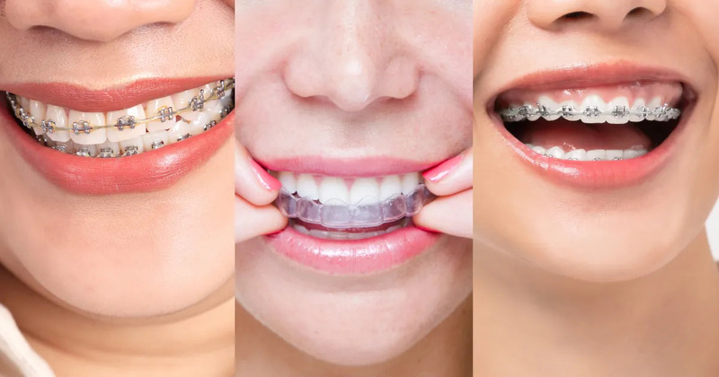 Các giải pháp niềng răng khi đã trồng implant hoặc làm cầu răng