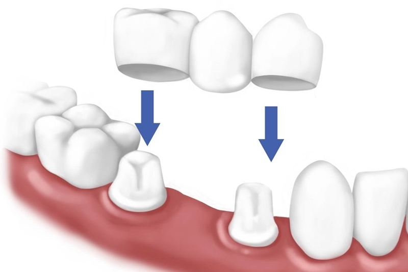 Mất 1 đến 2 răng liền kề là chỉ định thường gặp của cầu răng sứ