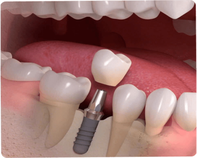 Implant thường là giải pháp phục hồi răng mất an toàn và tối ưu hơn