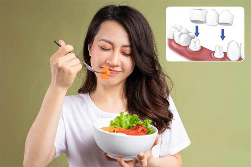 Cầu răng sứ có thể giúp phục hồi ăn nhai và thẩm mỹ khi mất răng