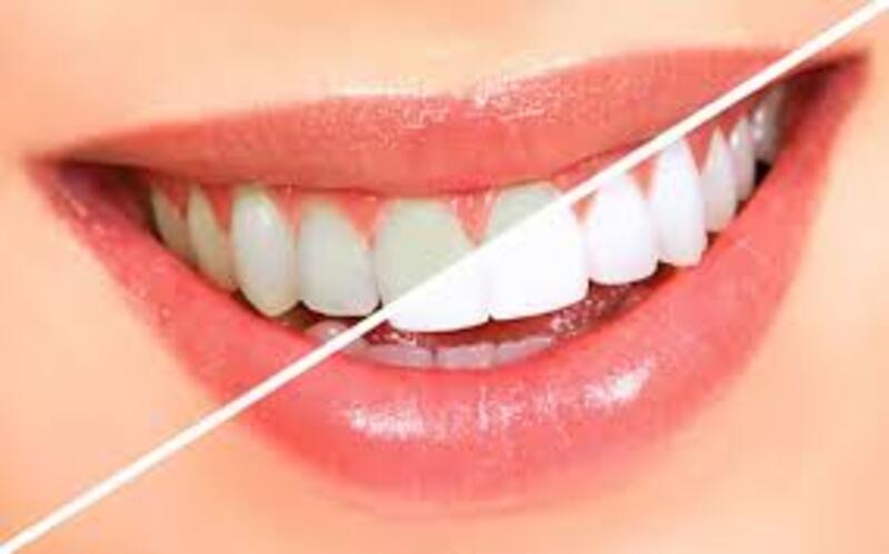 Phục hình răng sứ đúng kỹ thuật giúp hạn chế cảm giác cộm sau khi làm